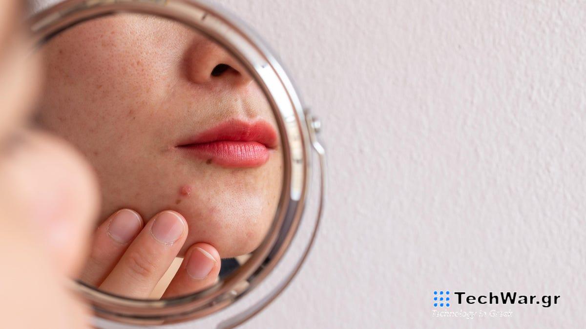 Τα άτομα με ακμή πληρώνουν μια απότομη κοινωνική τιμή, ευρήματα μελέτης