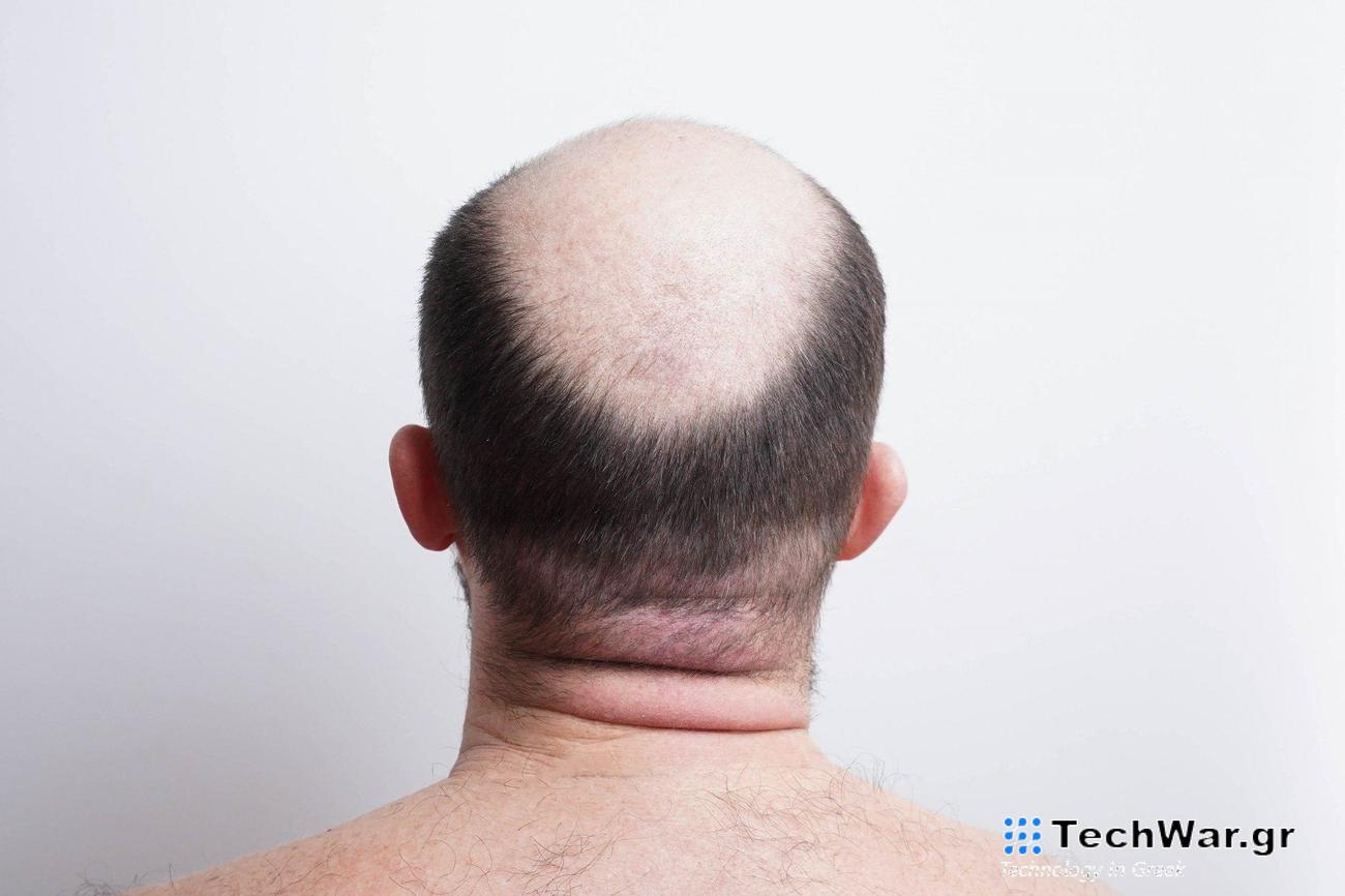 Έρχεται το εμβόλιο για τη φαλάκρα