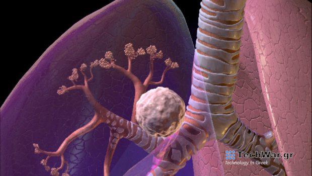 Ποιοι είναι οι πιο συχνοί τύποι καρκίνου στην Ελλάδα - Τι λέει καθηγητής ογκολογίας